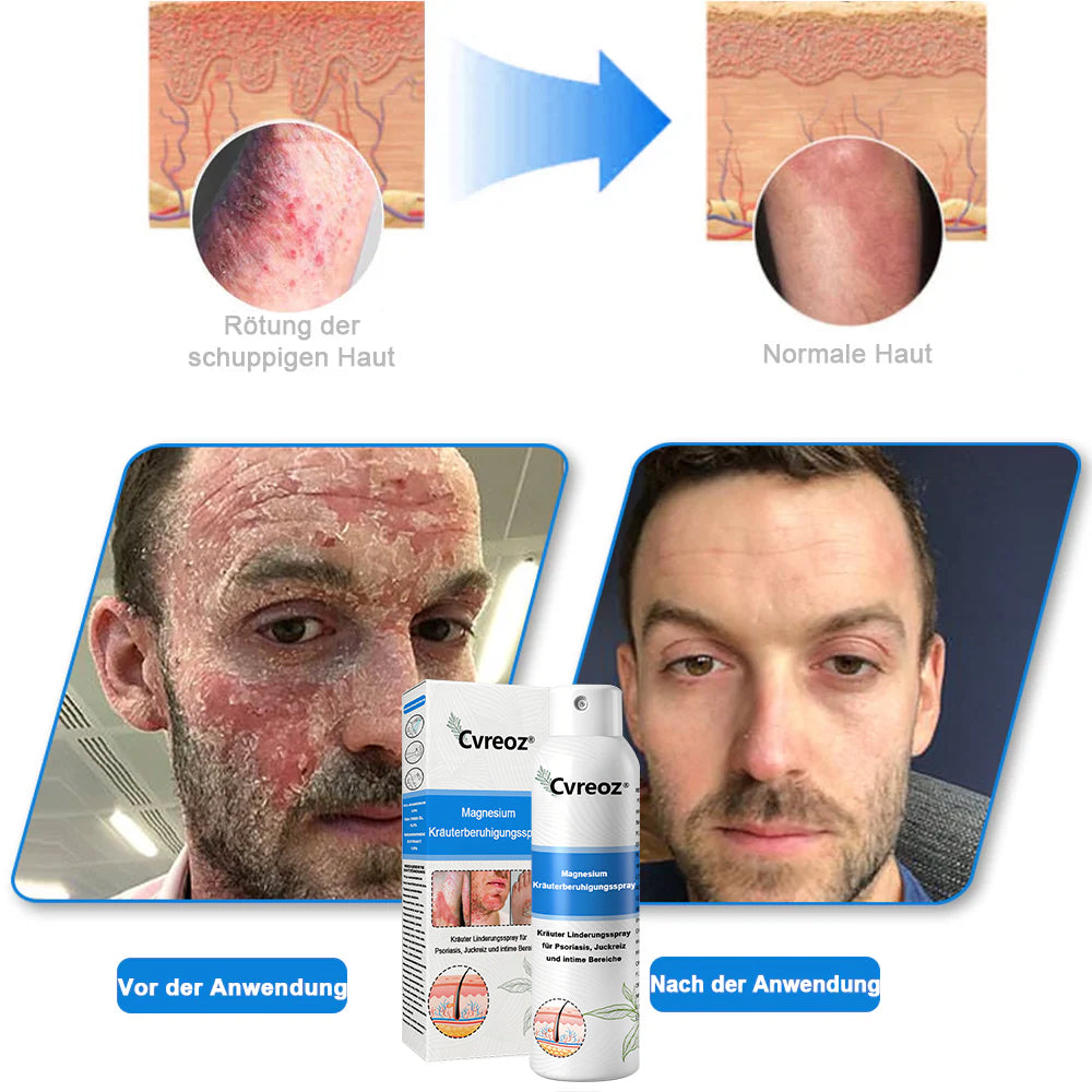 Offizieller Shop🎁: Cvreoz® Magnesium Kräuter Hautspray ⚕️ Entspricht den deutschen Hautpflege-Standards